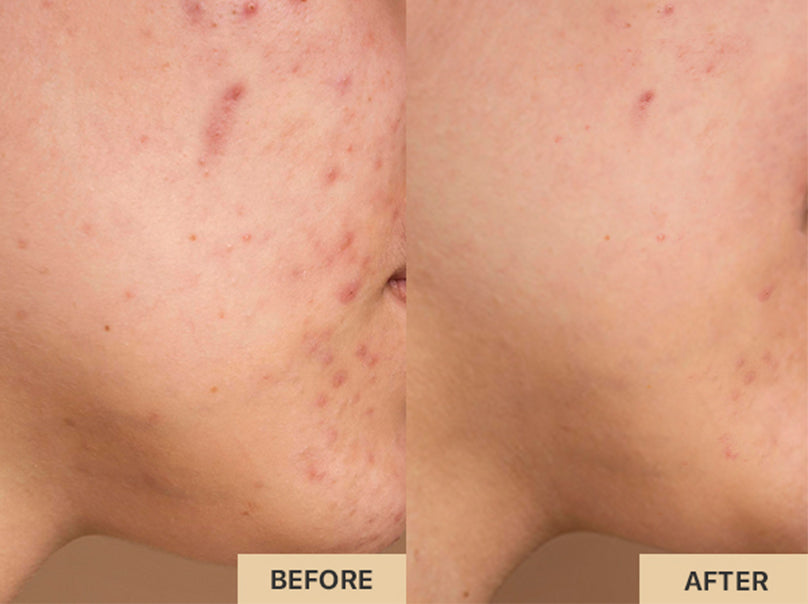 Red Light Therapy Mask Acne Reduction Before and After