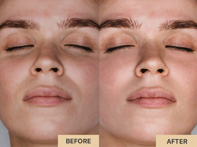 Red Light Therapy Mask Even Skin Tone Before and After