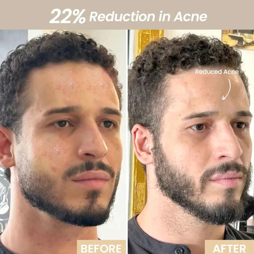 AMIRO Spectra 5-in-1 LED Light Therapy Facial Mask