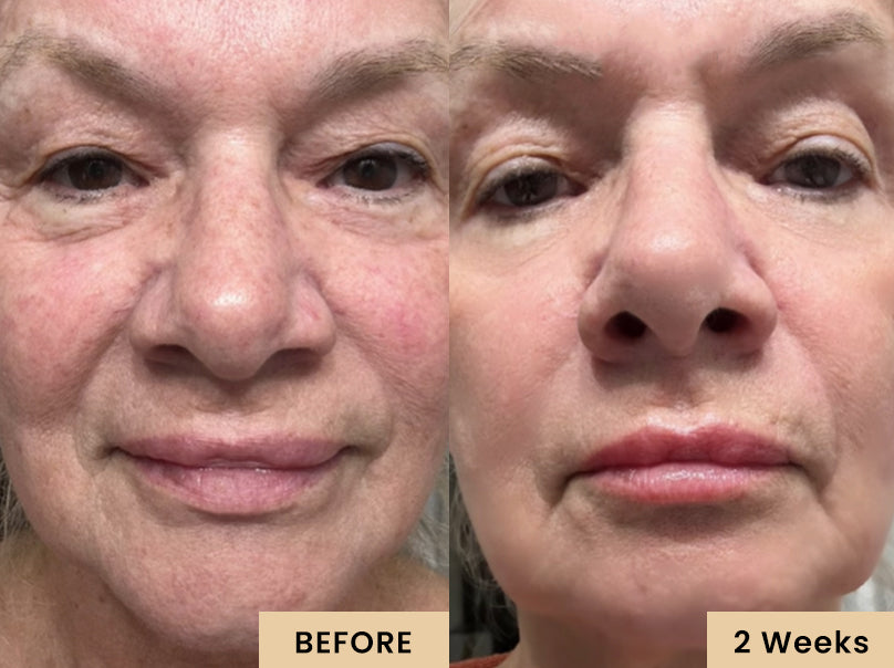 Red Light Therapy Mask Skin Rejuvenation Before and After