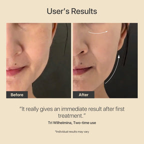 AMIRO R3 Turbo Facial RF Skin Tightening Device