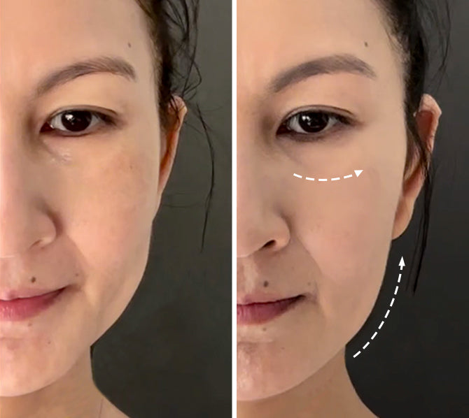 Jawline lifted after 28 days using AMIRO R3 Turbo