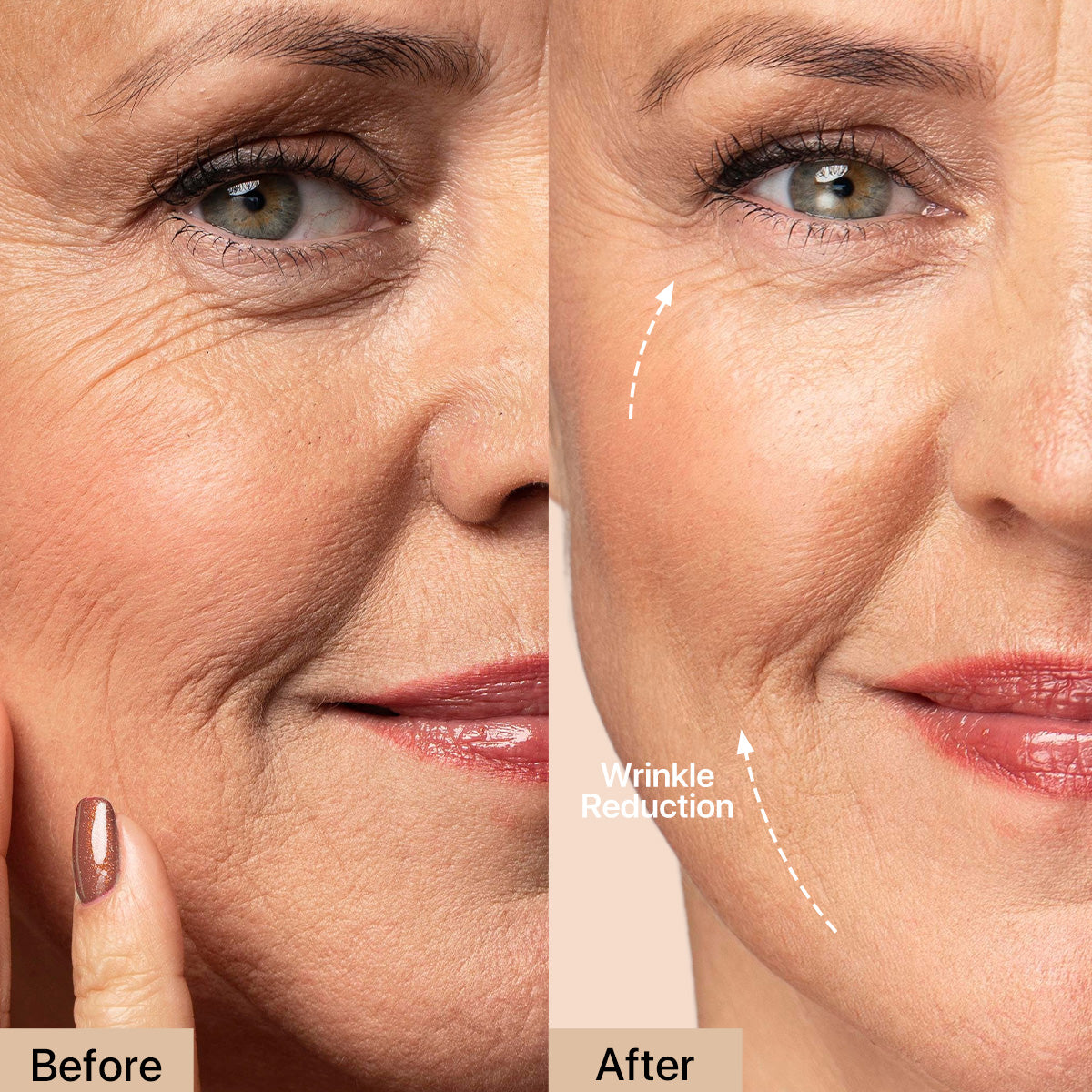 AMIRO R3 Turbo Radio Frequency skin tightening device before and after results showing improved skin firmness and reduced wrinkles.