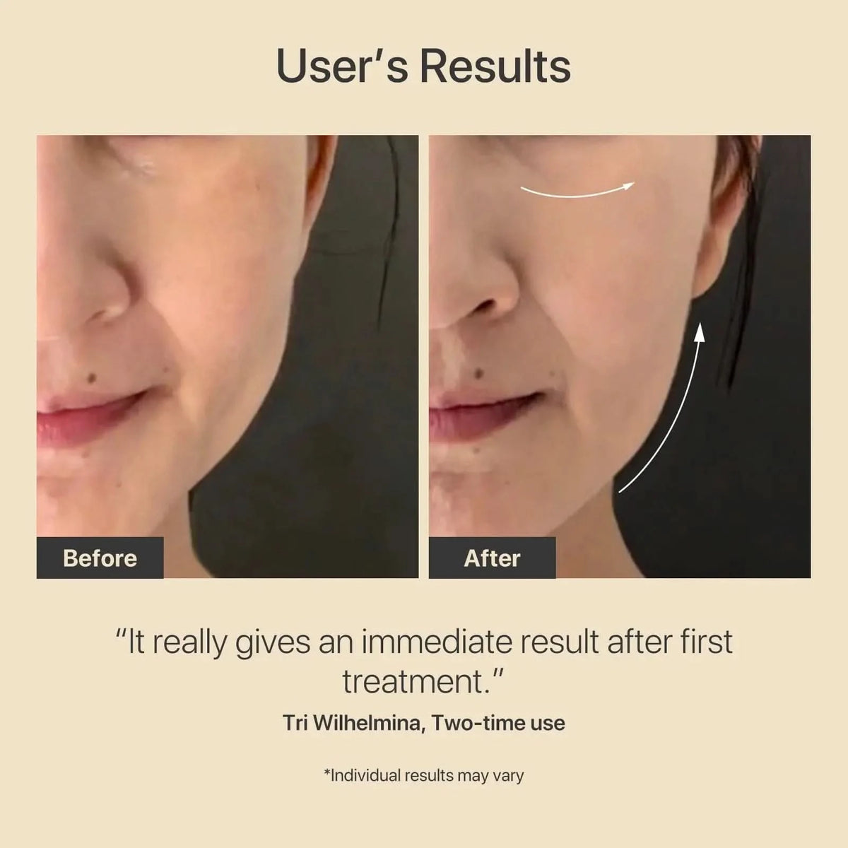 Amiro R3 Turbo Facial RF Beauty Tool