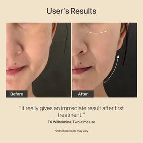 Customer's real results after two uses of the R3 Turbo: improved jawline, brighter eyes, reduced wrinkles.